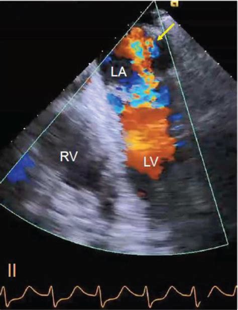 severe right ventricular hypokinesis.